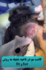 نمونه کاشت مو دکتر قاسم رحمت پور رکنی