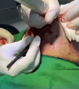 نمونه کاشت مو دکتر قاسم رحمت پور رکنی