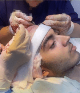 نمونه کاشت مو دکتر قاسم رحمت پور رکنی