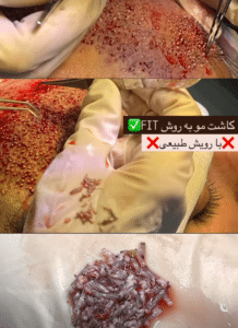 نمونه کاشت مو دکتر قاسم رحمت پور رکنی