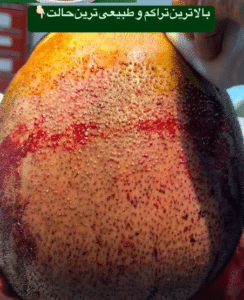 نمونه کاشت مو دکتر قاسم رحمت پور رکنی