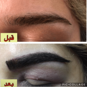 نمونه کاشت ابرو دکتر قاسم رحمت پور رکنی