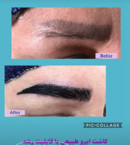 نمونه کاشت ابرو دکتر قاسم رحمت پور رکنی