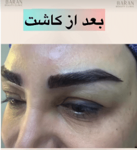 نمونه کاشت ابرو دکتر قاسم رحمت پور رکنی