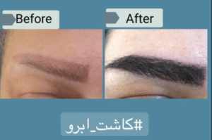 نمونه کاشت ابرو دکتر قاسم رحمت پور رکنی