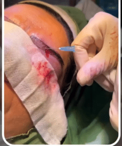 نمونه کاشت ابرو دکتر قاسم رحمت پور رکنی