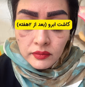 نمونه کاشت ابرو دکتر قاسم رحمت پور رکنی