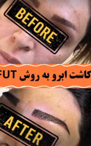 نمونه کاشت ابرو دکتر قاسم رحمت پور رکنی
