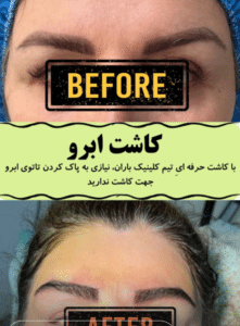 نمونه کاشت ابرو دکتر قاسم رحمت پور رکنی