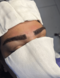 نمونه کاشت ابرو دکتر قاسم رحمت پور رکنی