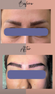 نمونه کاشت ابرو دکتر قاسم رحمت پور رکنی