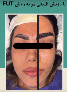 نمونه کاشت ابرو دکتر قاسم رحمت پور رکنی