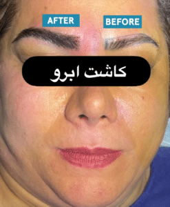 نمونه کاشت ابرو دکتر قاسم رحمت پور رکنی