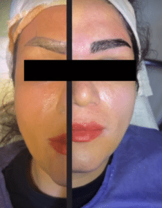 نمونه کاشت ابرو دکتر قاسم رحمت پور رکنی