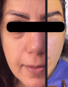 نمونه کاشت ابرو دکتر قاسم رحمت پور رکنی