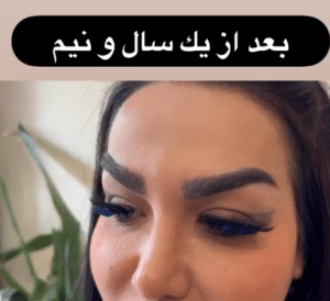 نمونه کاشت ابرو دکتر قاسم رحمت پور رکنی