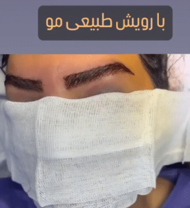 نمونه کاشت ابرو دکتر قاسم رحمت پور رکنی