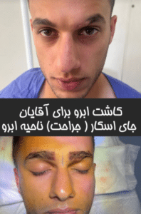 نمونه کاشت ابرو دکتر قاسم رحمت پور رکنی