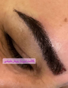 نمونه کاشت ابرو دکتر قاسم رحمت پور رکنی