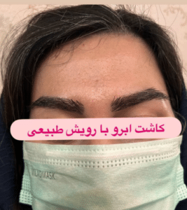 نمونه کاشت ابرو دکتر قاسم رحمت پور رکنی