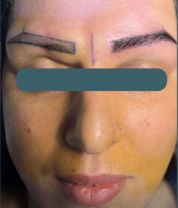 نمونه کاشت ابرو دکتر قاسم رحمت پور رکنی