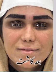 نمونه کاشت ابرو دکتر قاسم رحمت پور رکنی