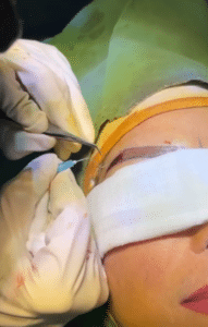 نمونه کاشت ابرو دکتر قاسم رحمت پور رکنی