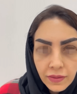 نمونه کاشت ابرو دکتر قاسم رحمت پور رکنی