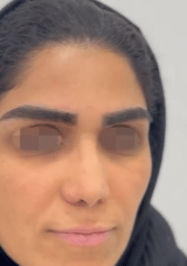 نمونه کاشت ابرو دکتر قاسم رحمت پور رکنی