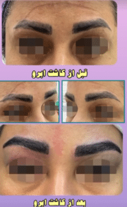 نمونه کاشت ابرو دکتر قاسم رحمت پور رکنی
