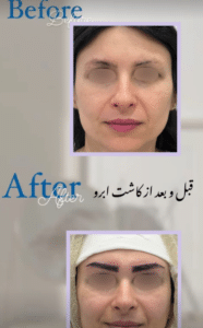 نمونه کاشت ابرو دکتر قاسم رحمت پور رکنی