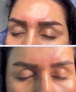نمونه کاشت ابرو دکتر قاسم رحمت پور رکنی