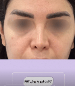 نمونه کاشت ابرو دکتر قاسم رحمت پور رکنی
