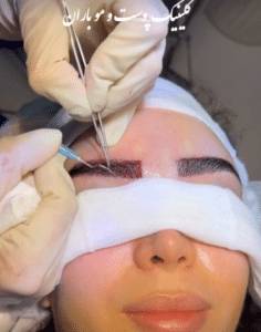 نمونه کاشت ابرو دکتر قاسم رحمت پور رکنی