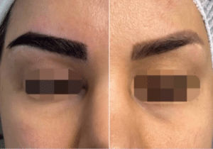 نمونه کاشت ابرو دکتر قاسم رحمت پور رکنی
