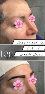 نمونه کاشت ابرو دکتر قاسم رحمت پور رکنی