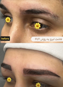 نمونه کاشت ابرو دکتر قاسم رحمت پور رکنی