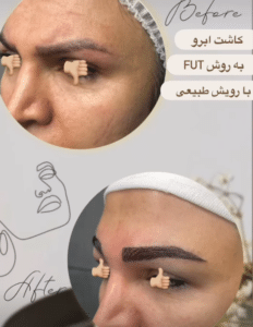 نمونه کاشت ابرو دکتر قاسم رحمت پور رکنی