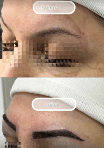 نمونه کاشت ابرو دکتر قاسم رحمت پور رکنی
