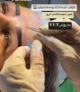 نمونه کاشت ابرو دکتر قاسم رحمت پور رکنی