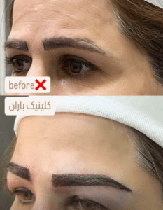 نمونه کاشت ابرو دکتر قاسم رحمت پور رکنی