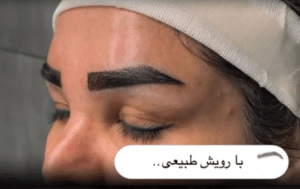 نمونه کاشت ابرو دکتر قاسم رحمت پور رکنی