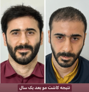 نمونه کاشت مو دکتر گالیا رنجبری