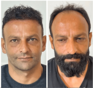 نمونه کاشت مو دکتر گالیا رنجبری