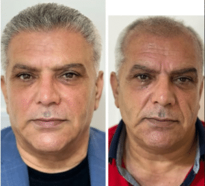 نمونه کاشت مو دکتر گالیا رنجبری