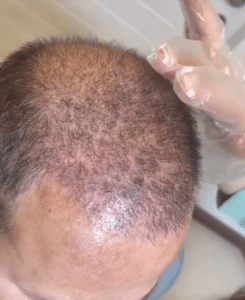 نمونه کاشت مو دکتر گالیا رنجبری