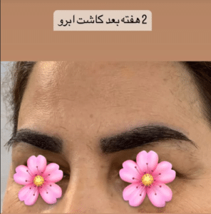 نمونه کاشت مو دکتر گالیا رنجبری