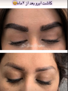 نمونه کاشت ابرو دکتر گالیا رنجبری