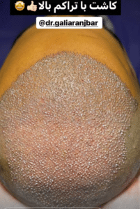 نمونه کاشت مو دکتر گالیا رنجبری