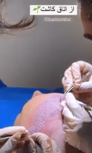 نمونه کاشت مو دکتر گالیا رنجبری